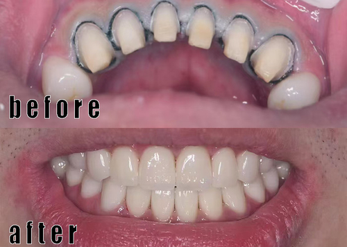 corona di biossido di zirconio