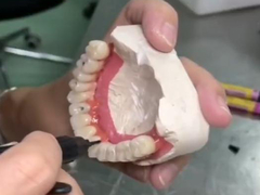 Prontiera completa fissa di lunga durata con ponte corona ceramica a base di titanio per il restauro dentale