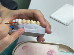 Corone in ceramica traslucida per la restauro dentale con estetica naturale e facile pulizia