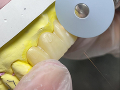 Corona di zirconia solida traslucida con estetica naturale
