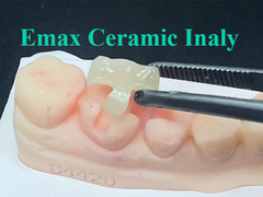 L'intaglio Emax Ceramic, realizzato su misura per la sua posizione