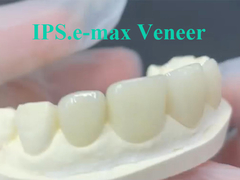 EMAX Veneer La soluzione ideale per restauri dentali duraturi ed estetici