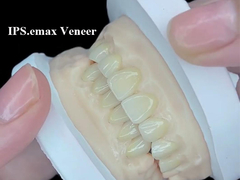 IPS.emax Veneer Soluzione estetica premium per trasformazioni di sorrisi mozzafiato