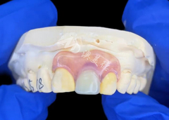 Protesi parziali Nesbit per incisivi che offrono una soluzione di sostituzione dei denti rimovibile senza saldature