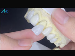 IPS Emax Veneers Minimal Prep/ No-prep Veneers sono soluzioni innovative per un bel sorriso