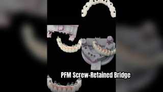Restauro implantare avvitato PFM di precisione