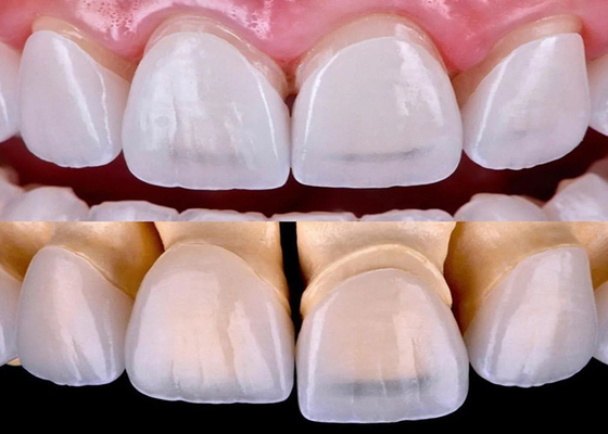 comprare Finitura dentale EMAX di lunga durata realizzata con tutto il materiale circonico ceramico online manufacture