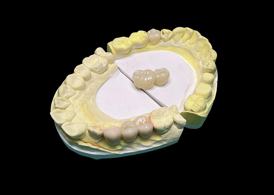 comprare Corone e ponti in ceramica di traslucidità avanzata migliorano il tuo sorriso con precisione ed estetica naturale per una durata lunga online manufacture