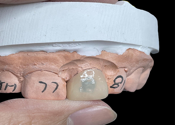 comprare I rivestimenti EMAX trasformano il tuo sorriso con denti dall'aspetto naturale altamente traslucido online manufacture