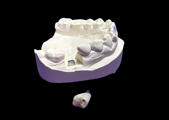 comprare Impianto dentale con corona di ceramica e abuto di titanio per molari online manufacture