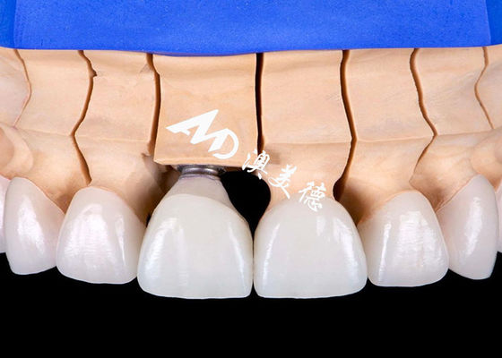 comprare Ponte per corona di impianto dentale con base in lega di titanio biocompatibile con estetica dall'aspetto naturale online manufacture