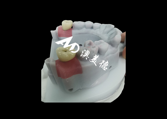 comprare Corona di impianto dentale con pilastro in titanio per il restauro dei denti durevole online manufacture