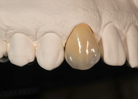 comprare Resistenza alle macchie Corona di zirconia solida per denti anteriori denti posteriori online manufacture
