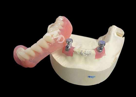 comprare Soluzione per l'overdenture con l'implant Locator Bar per una masticazione e un linguaggio migliori online manufacture