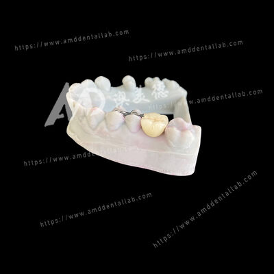 comprare PFM Maryland Bridge Unico Ponte Due Alette Una Soluzione Conservativa ed Estetica online manufacture