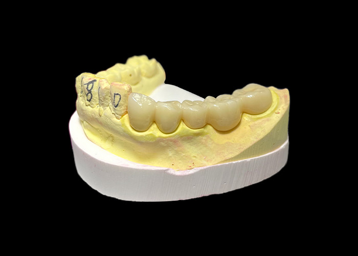 Corona dentale in porcellana di zirconia di alta qualità Forza ineguagliabile Precisione adatta e estetica e durata eccezionali