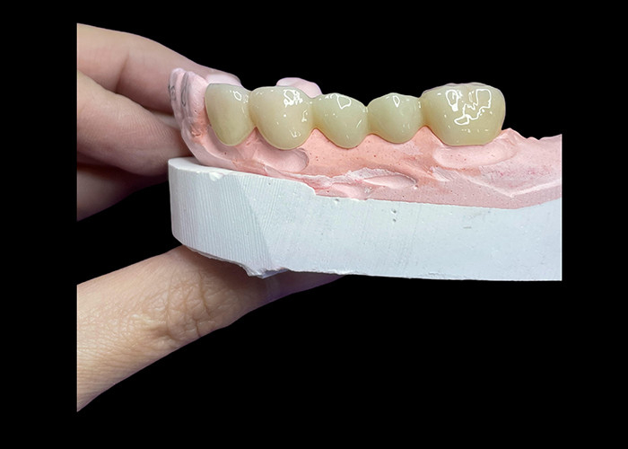 Tutte le corone e i ponti in ceramica progettati per un'estetica superiore, durabilità e adattamento naturale per una fiducia duratura