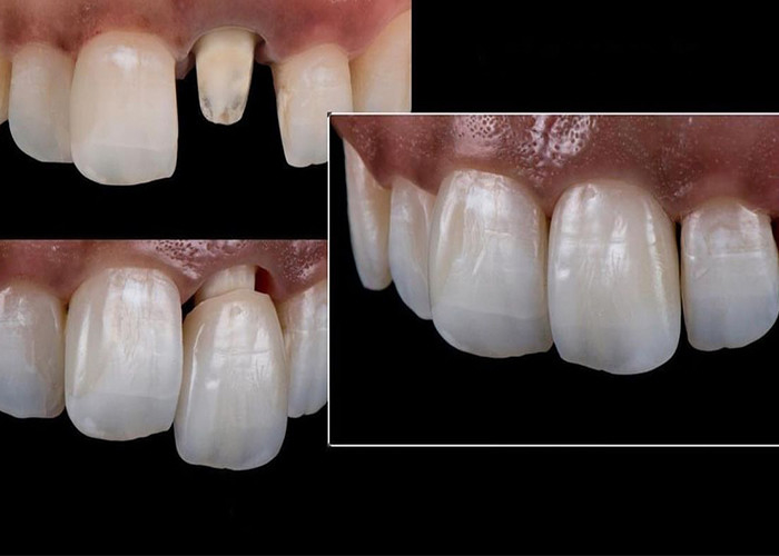 Tutte le corone e i ponti in ceramica progettati per un'estetica superiore, durabilità e adattamento naturale per una fiducia duratura