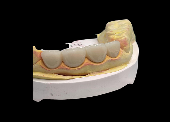 Lunga durata resistente all'usura Forza tutto ponte corona in ceramica con eccellente biocompatibilità per il restauro dentale