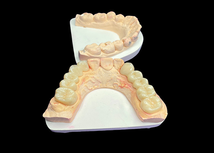 Corone di ceramica traslucida per il restauro dentale con facile pulizia e risultati duraturi