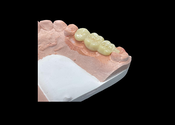 Corone di ceramica traslucida per il restauro dentale con facile pulizia e risultati duraturi
