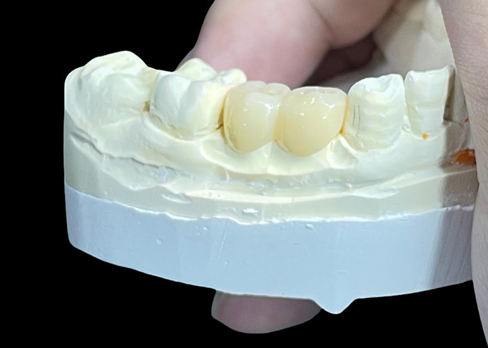 Corone e ponti in ceramica personalizzati per un'adeguatezza perfetta e prestazioni durature
