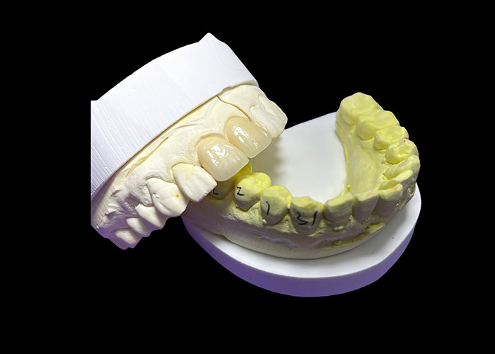 Corone e ponti in ceramica personalizzati per un'adeguatezza perfetta e prestazioni durature