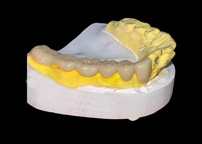 Corone e ponti in ceramica personalizzati per un'adeguatezza perfetta e prestazioni durature