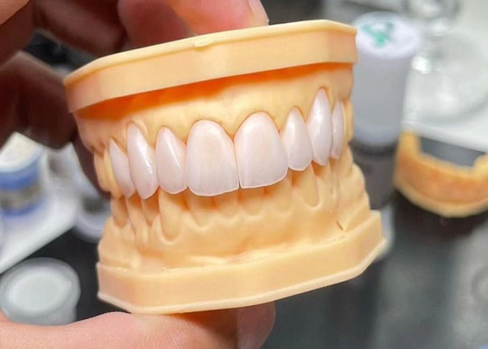 Ponte a corona in ceramica ad alta resistenza con eccezionale biocompatibilità per una durata lunga