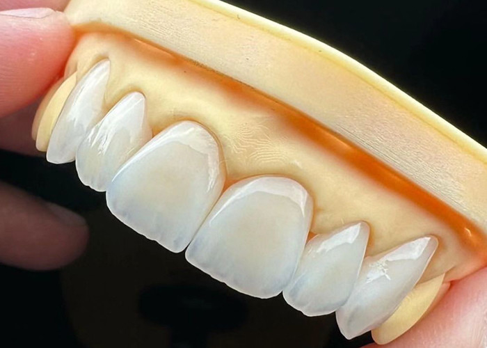 Ponte a corona in ceramica ad alta resistenza con eccezionale biocompatibilità per una durata lunga