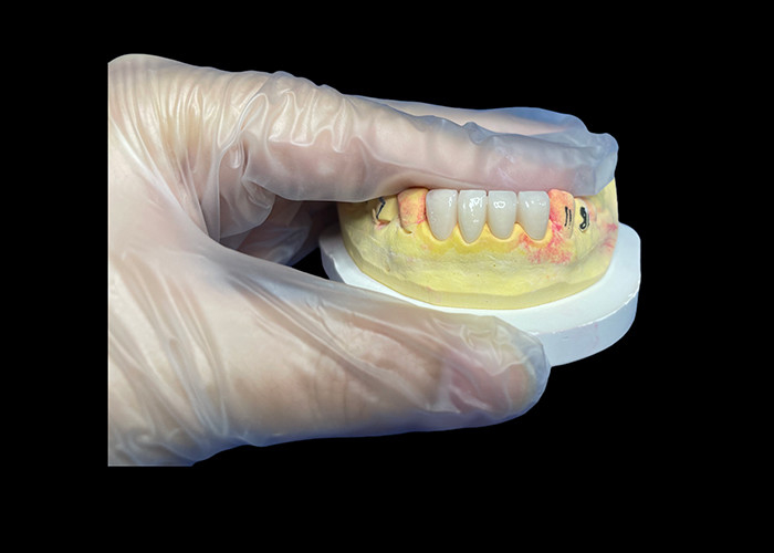 Ponte di corona in ceramica resistente all'usura per un comodo e preciso restauro dentale