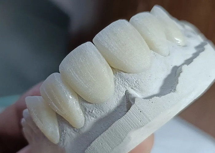 Ponte di corona in ceramica resistente all'usura per un comodo e preciso restauro dentale