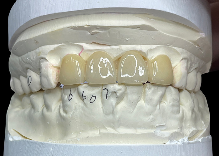 Resistente alle macchie Tutto ponte di porcellana Comodo adatto per la restaurazione dentale