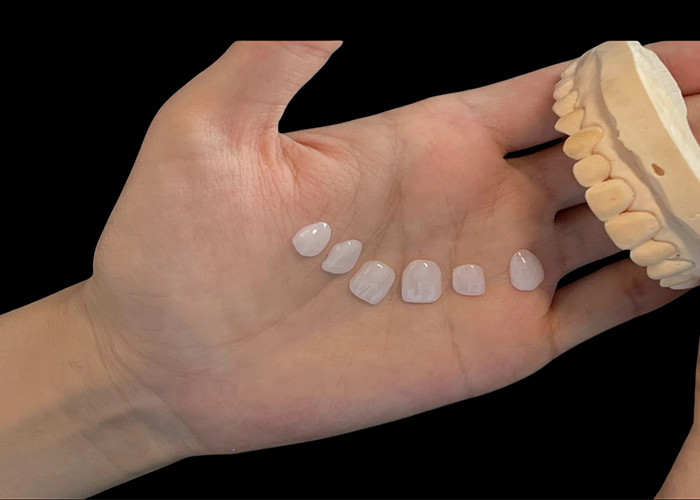 Sfumatura di porcellana ultra sottile Veneers EMAX resistente alle macchie per restauri estetici