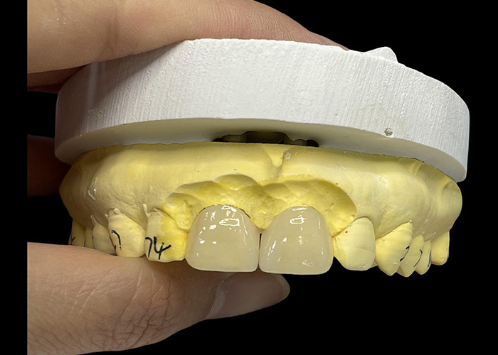 Sfumatura di porcellana ultra sottile Veneers EMAX resistente alle macchie per restauri estetici