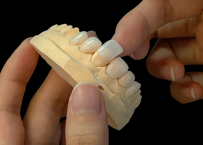 Sfumatura di porcellana ultra sottile Veneers EMAX resistente alle macchie per restauri estetici