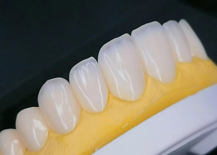 Veneer di porcellana EMAX con resistenza alle macchie per restauri estetici dall'aspetto naturale