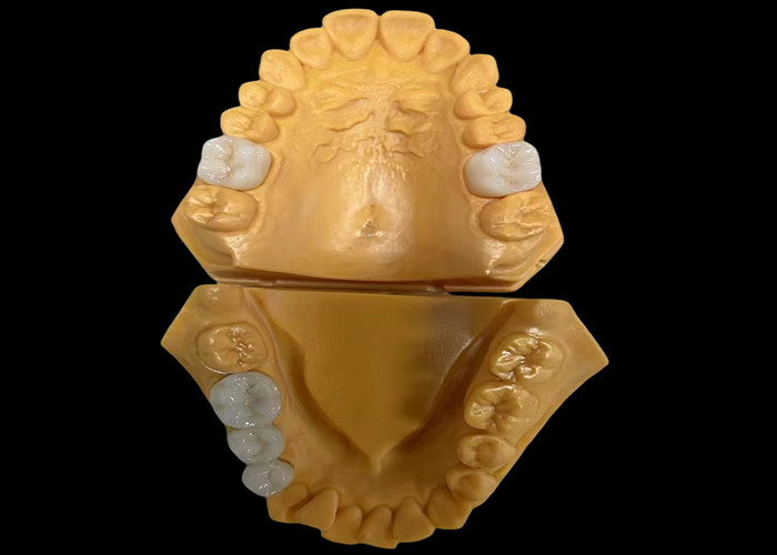 Corona dentale in zirconia estetica personalizzata perfettamente adattata per denti anteriori e posteriori