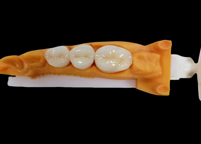 Corona dentale in zirconia resistente all'usura con resistenza ai frammenti e alle macchie e estetica naturale dal laboratorio dentale cinese