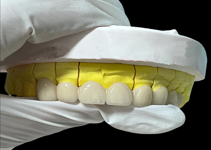 Corona dentale in porcellana di zirconia con finitura estetica e naturale proveniente dal laboratorio dentale cinese
