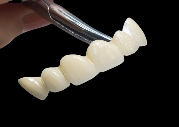 Corona dentale di zirconia traslucida su misura resistente alle macchie