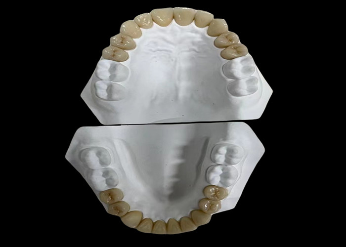 Confortevole ponte dentale in porcellana con costruzione interamente in ceramica per una resistenza all'usura eccezionale