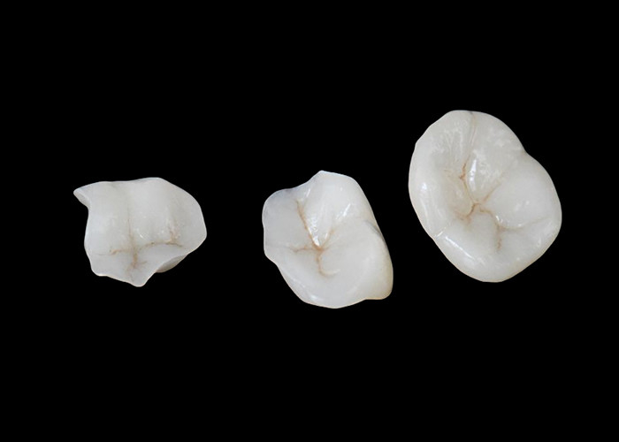 Infissi e infissi in ceramica biocompatibili progettati per una durabilità confortevole e un'integrazione senza soluzione di continuità con i denti naturali