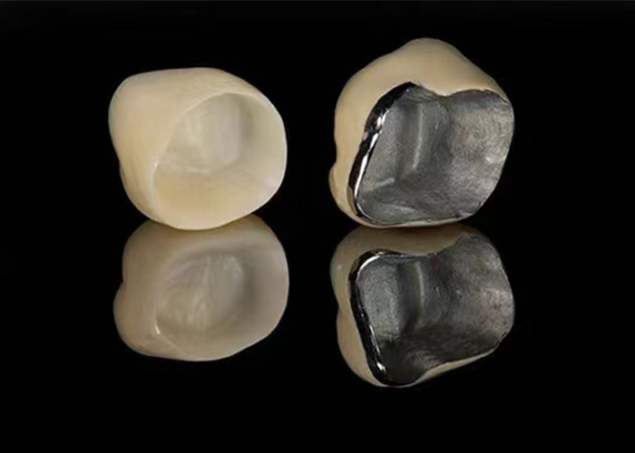 Porcellana naturale fusa a corona di metallo per ripristinare i denti danneggiati