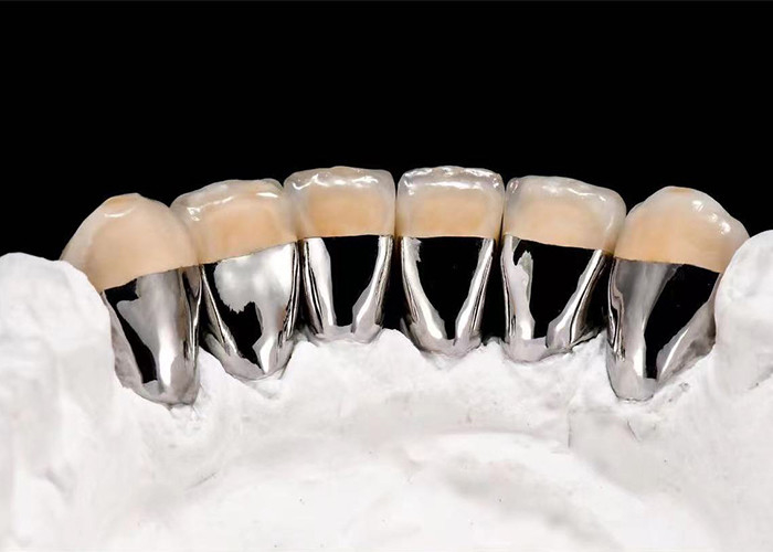 Porcellana naturale fusa a corona di metallo per ripristinare i denti danneggiati