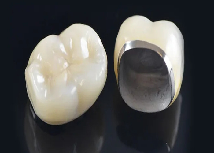 Porcellana naturale fusa a corona di metallo per ripristinare i denti danneggiati