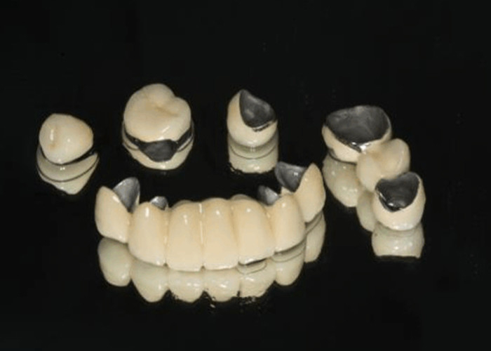 Porcellana fusa al metallo PFM corona resistenza all'usura dentale per la odontoiatria restauratrice