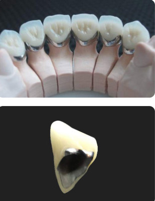 Porcellana fusa al metallo PFM corona resistenza all'usura dentale per la odontoiatria restauratrice