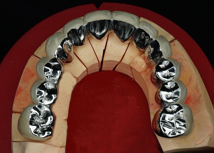 Porcellana di restauro altamente resistente fusa con corona metallica per un sorriso naturale