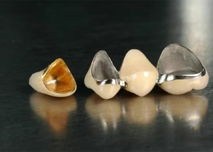 Porcellana di restauro altamente resistente fusa con corona metallica per un sorriso naturale